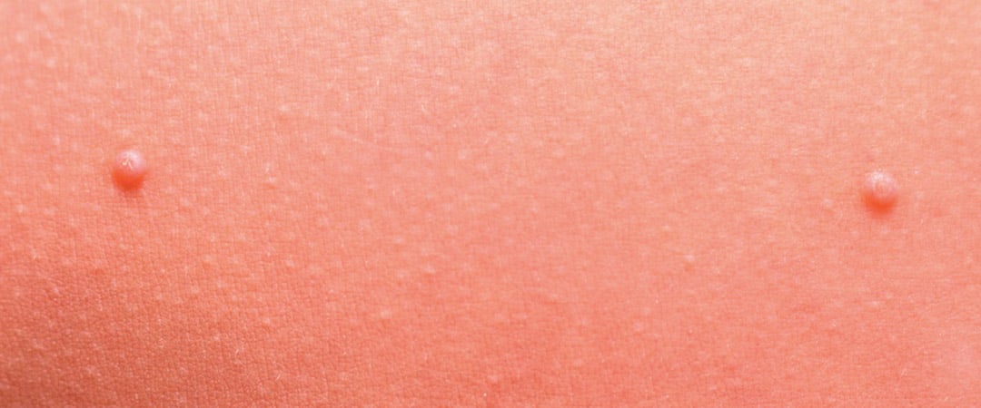 MOLUSCO-CONTAGIOSO-ITS-MAS-COMUNES-INFECCIÓN-DE-TRANSMISIÓN-SEXUAL-ETS